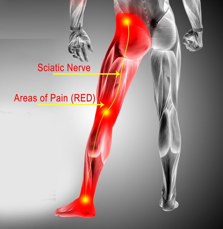 Understanding Sciatica: Causes, Symptoms, and Why LeBron James’s Injury Is Shedding Light on It